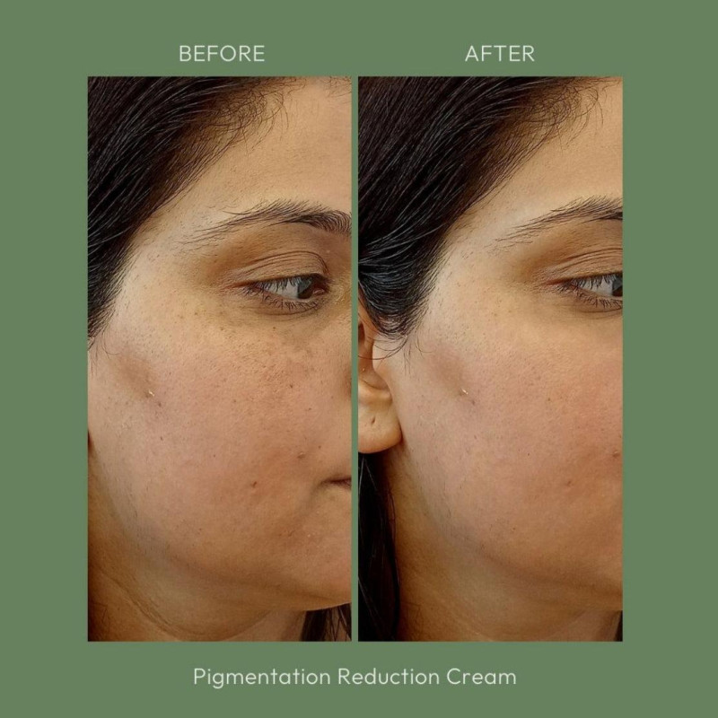 Kamill Sunder Kaya Fairness Cream For Pimples, Blemishes And Acne (12 gms)