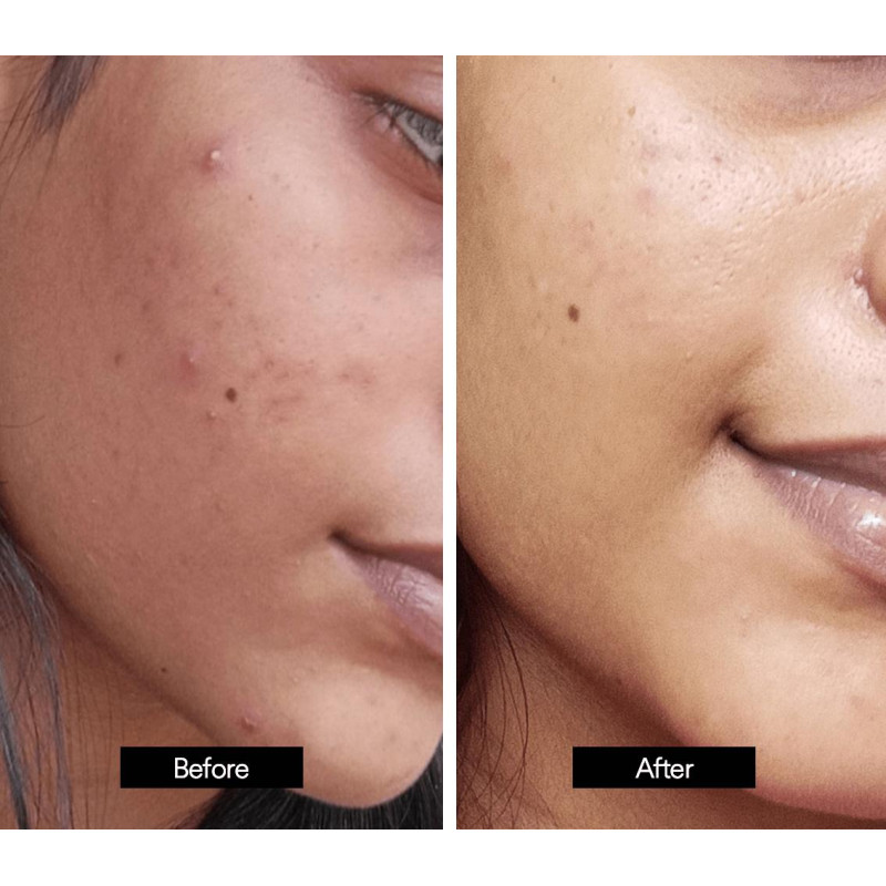 Kamill Sunder Kaya Fairness Cream For Pimples, Blemishes And Acne (12 gms)